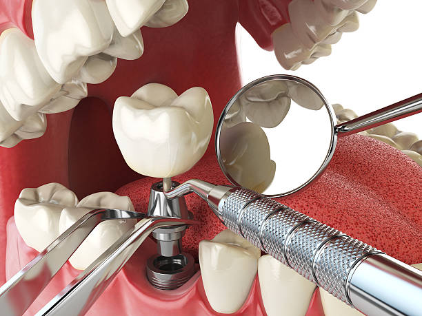 Best Dental Abscess Treatment in Rio Pinar, FL